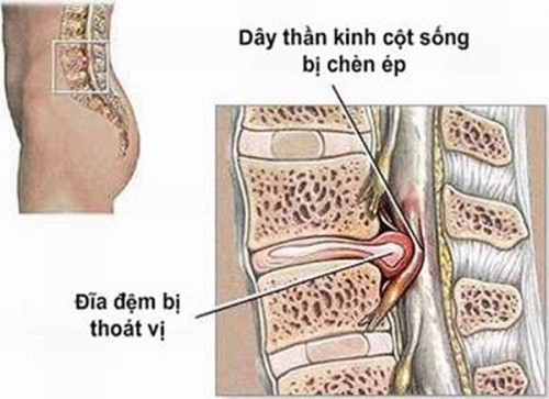Hình ảnh người bị thoát vị đĩa đệm -một trong những nguyên nhân gây chứng đau thần kinh tọa