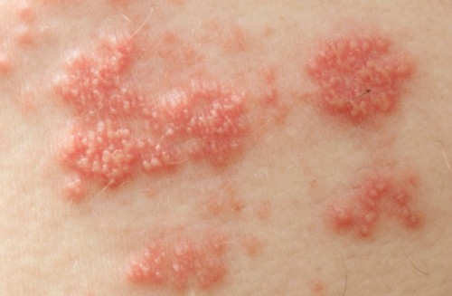 Bệnh lupus ban đỏ có chữa được không?
