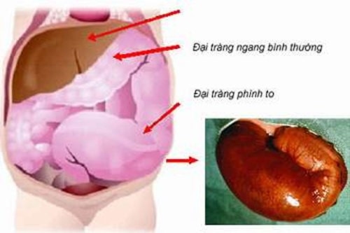 bệnh phình đại tràng bẩm sinh là dị tật nguy hiểm về đường tiêu hóa cần điều trị sớm