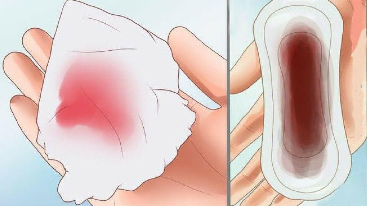 Đặt vòng xong bị chảy máu nhiều có làm sao không?