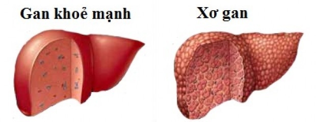 viem-gan-b-va-nhung-bien-chung-nguy-hiem.jpg2
