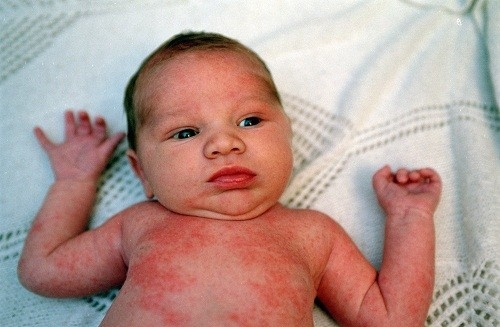 Chàm Eczema cũng là một trong các bệnh ngoài da thường gặp ở trẻ sơ sinh.