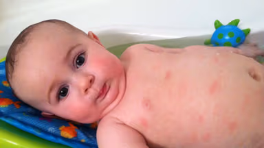 Bệnh nấm da ở trẻ nhỏ, bố mẹ không nên chủ quan