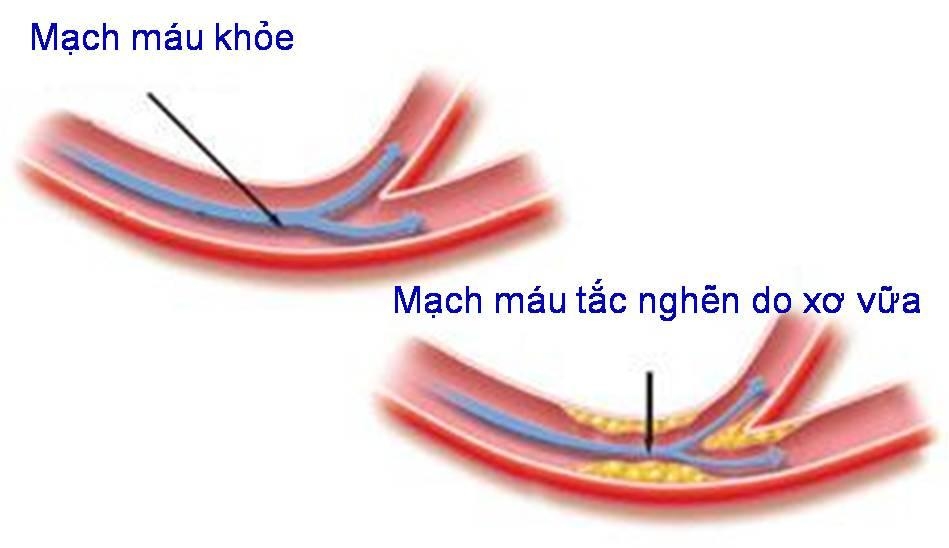 xo-vua-dong-mach-nguyen-nhan-khoi-phat-benh