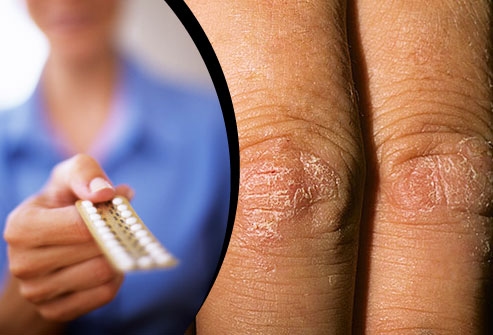 . Các nhà nghiên cứu cho rằng có mối liên kết giữa hormones và bệnh vẩy nến.