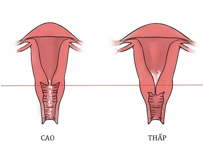 Vị trí cổ tử cung bất thường chắc chắn sẽ ảnh hưởng đến thiên chức làm mẹ của chị em phụ nữ.