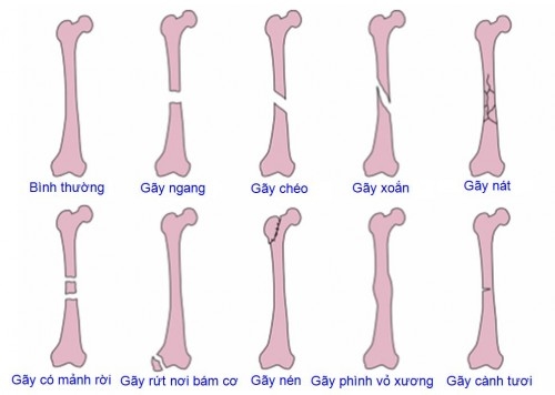 Các trường hợp gãy xương