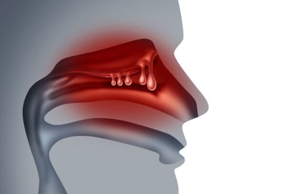 Viêm xoang kéo dài mà không điều trị có thể tiến triển thành mạn tính