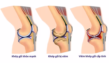 Chữa viêm khớp cấp tính