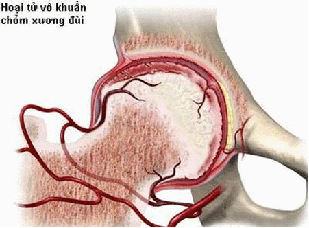 Nguyên nhân gây bệnh hoại tử vô khuẩn chỏm xương đùi