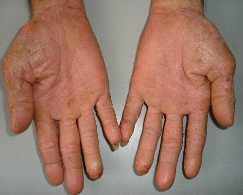 Bệnh tổ đỉa, một dạng của bệnh chàm, có thể gây ngứa ở bàn tay và bàn chân.