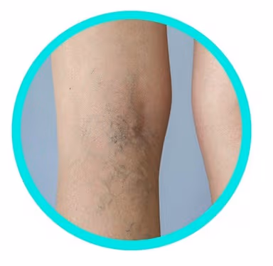 Siêu âm mạch máu là gì? sử dụng sóng âm để kiểm tra