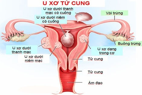U xơ tử cung là những khối tăng trưởng của mô cơ tử cung.