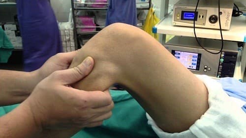 Sau mổ nội soi tái tạo dây chằng chéo khớp gối, người bệnh cần phải trải qua giai đoạn quan trọng là tập luyện