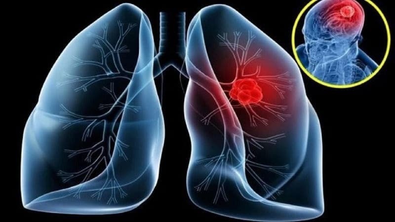 Dữ liệu thống kê của Anh về tỷ lệ tử vong do các bệnh ung thư. Trong đó, ung thư phổi chiếm tỷ lệ tử vong cao nhất.