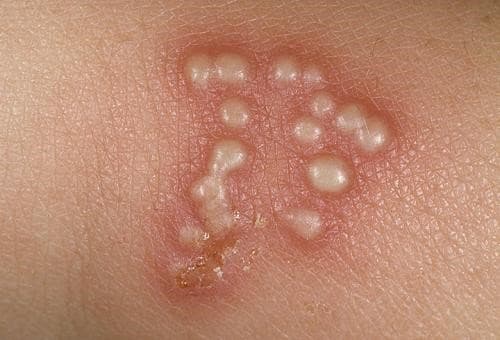 Sùi mào gà là một trong những bệnh lây truyền qua đường tình dục.