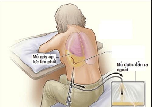 Bệnh lao màng phổi có nguy hiểm không?