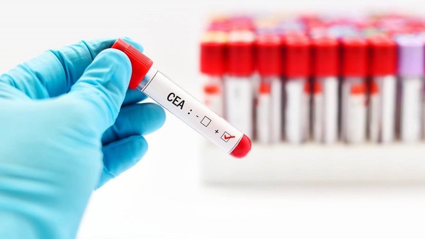 Chỉ số CEA trong máu là gì, có ý nghĩa như thế nào?