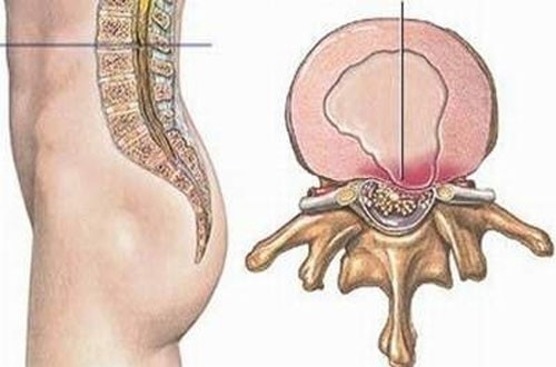 Thoát vị đĩa đệm là tình trạng cấu trúc đĩa đệm phình ra gây chèn ép vào các cấu trúc lân cận, biểu hiện là đau vùng thắt lưng