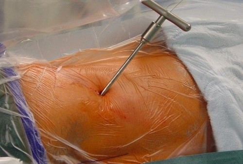 Nội soi thoát vị đĩa đệm là một phương pháp điều trị ít xâm lấn, được sử dụng rộng rãi hiện nay