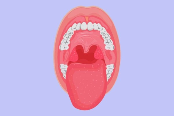 Viêm amidan hốc mủ là một thể viêm amidan nghiêm trọng, ảnh hưởng không nhỏ tới sức khỏe của người bệnh