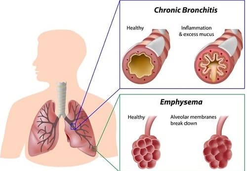Giãn phế nang là tình trạng phế nang và tiểu phế quản tận cùng bị căng giãn liên tục, vĩnh viễn không hồi phục,