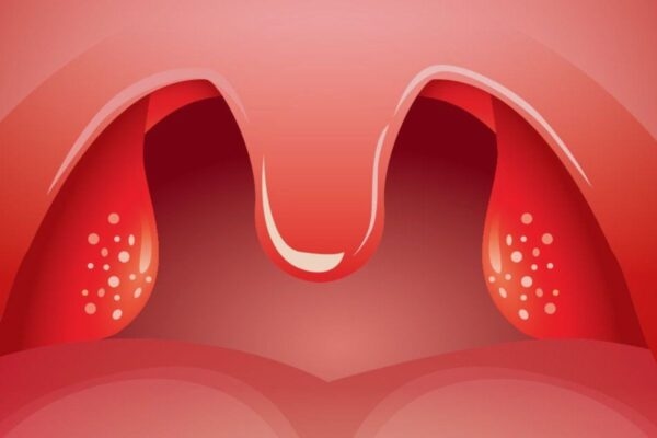 Viêm tai giữa, viêm amidan, viêm cầu thận... là các biến chứng nguy hiểm của bệnh viêm xoang