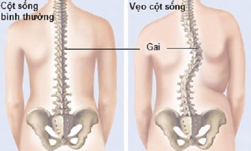 Nguyên nhân và hậu quả chứng cong vẹo cột sống