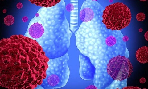 Viêm phổi do nấm là hiện tượng nhiễm trùng phổi do nấm Pneumocystis jiroveci