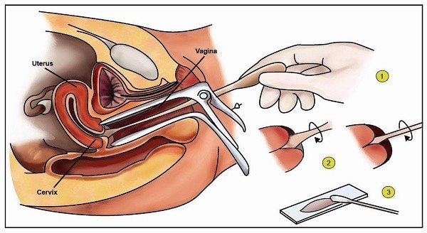 Xét nghiệm pap smear cần thiết để chẩn đoán bệnh lý phụ khoa