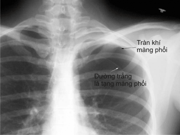 Tràn khí màng phổi là hiện tượng không khí tràn vào khoang màng phổi tách lá thành và lá tạng ra tạo một khoang chứa khí