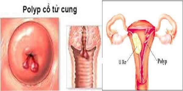 Polyp cổ tử cung cần được phát hiện sớm và điều trị hiệu quả
