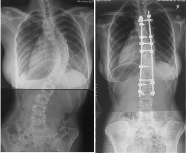 Mổ cột sống có nguy hiểm không?