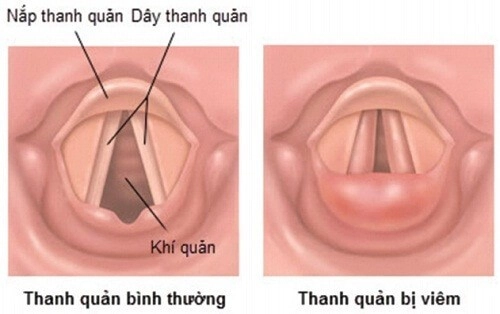 Nắp thanh quản được cấu tạo từ sụn có hình tương tự như lá cây và nằm ở đáy lưỡi.