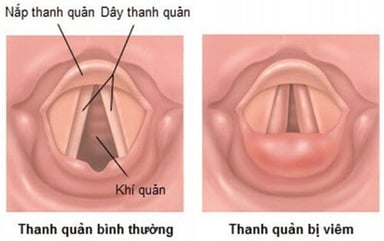 Nguyên nhân và triệu chứng viêm nắp thanh quản ở trẻ em