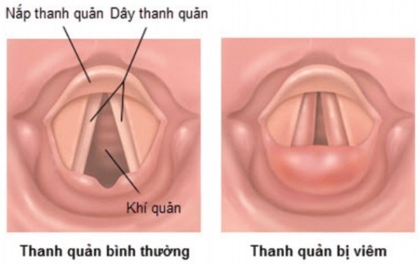 Viêm thanh quản mạn tính gây mất tiếng hoặc khản tiếng kéo dài trong nhiều tuần, thậm chí vài tháng.