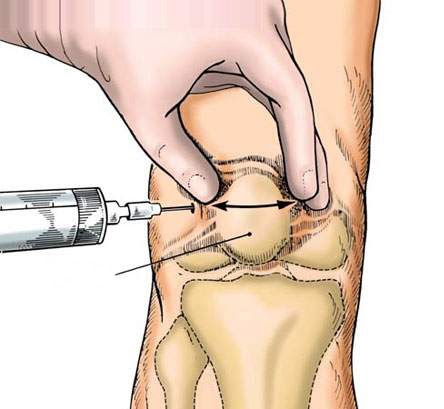 phuong-phap-dieu-tri-va-cach-phong-tranh-tran-dich-khop-goi-2