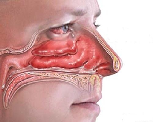 Các yếu tố gây viêm mũi dị ứng cấp tính có thể từ ngoài vào hốc mũi hoặc bằng đường máu