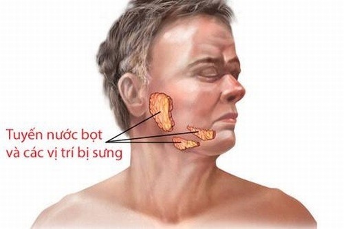 Bệnh quai bị là bệnh nhiễm virus của các tuyến nước bọt