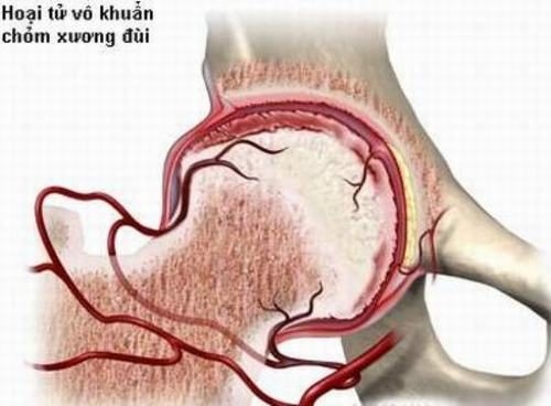 Nguyên nhân gây hoại tử chỏm xương đùi là do chỏm xương đùi bị phá hủy vì thiếu nuôi dưỡng.