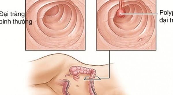 Polyp đại trực tràng cần được phát hiện và điều trị hiệu quả