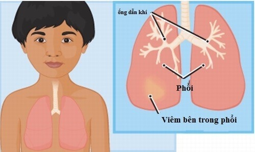 Chủ động phòng ngừa bệnh viêm phổi ở trẻ nhỏ