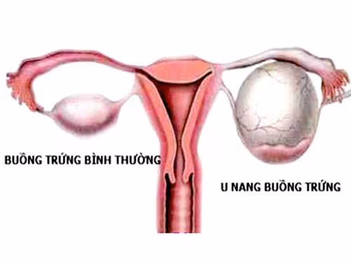 U nang buồng trứng là một loại khối u thường gặp ở nữ giới