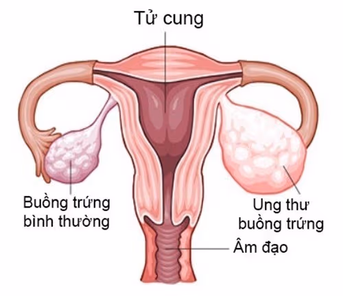 U nang thực thể hoàn toàn có khả năng biến chứng gây ung thư và đe dọa đến tính mạng của người bệnh.