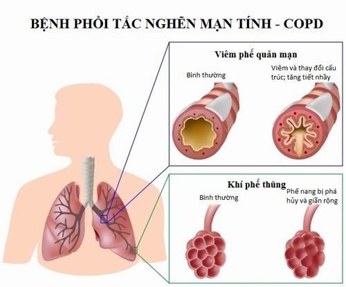 Viêm phổi tắc nghẽn mạn tính là một bệnh lý khá nguy hiểm