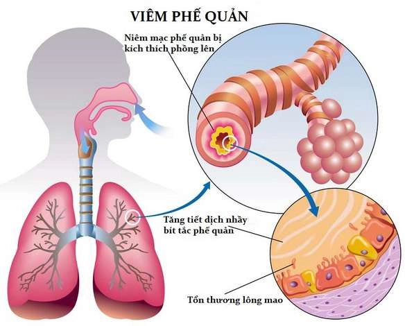 Viêm khí phế quản là tình trạng viêm cấp tính niêm mạc cây phế quản. Đây là một trong 6 bệnh viêm phổi và viêm phế quản thường gặp ở trẻ