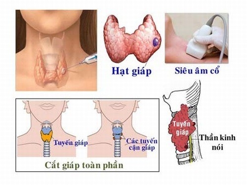 U tuyến giáp lành tính có nên phẫu thuật không cần phụ thuộc vào kích thước và vị trí của u