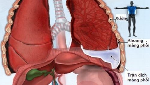 Tràn dịch màng phổi có thể do viêm phổi do vi khuẩn họ cầu khuẩn, Hemophilus influenzae, St. pneumoniae,....