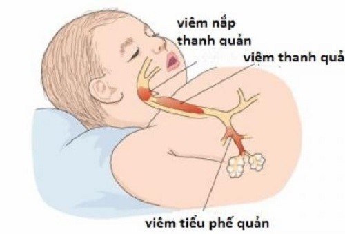 Virus hợp bào hô hấp (RSV) là nguyên nhân dẫn đến viêm tiểu phế quản.
