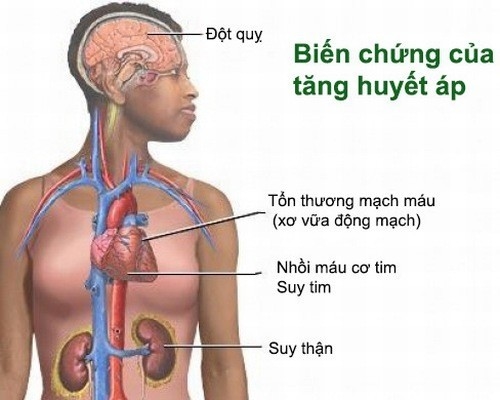 Biến chứng tăng huyết áp